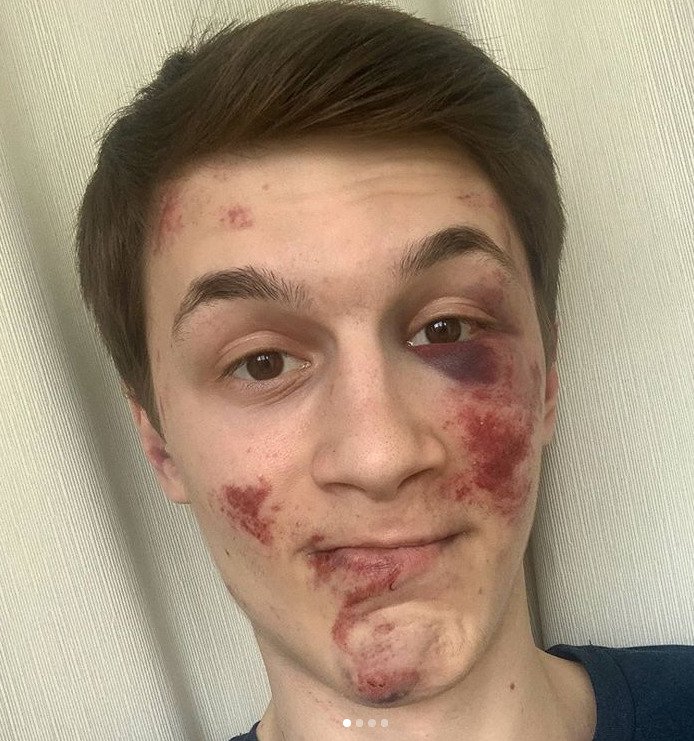 Ruský opoziční bloger Jegor Žukov. Zranění zbitého blogera se pomalu hojí, (1.09.2020).