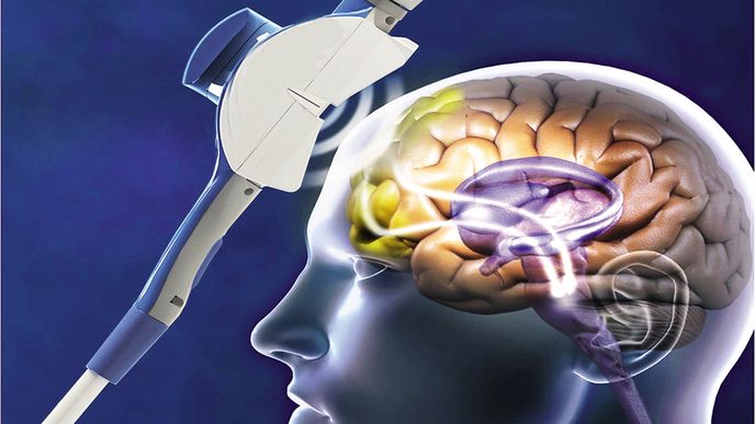 Stimulace mozku magnetickými pulsy dokáže výrazně zlepšit paměť