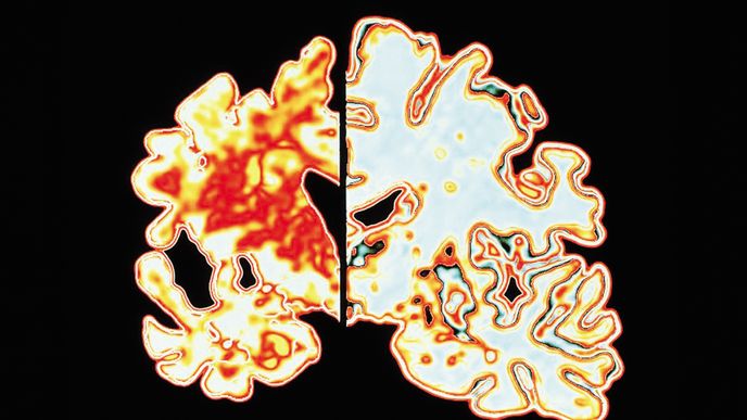 Alzheimerova choroba je důsledkem úbytku funkčních neuronů v mozku