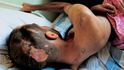 Paralyzovaný muž, který přežil tři zásahy do hlavy, je hospitalizovaný v tureckém Reyhanli