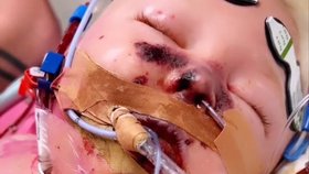 Malý Ryan Linese utrpěl septický šok a museli mu amputovat obě nožičky.
