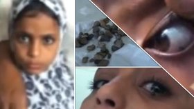 Jemenská dívka pláče kameny. Nikdo neví, co jí je. Místní si myslí, že posednutá ďáblem.