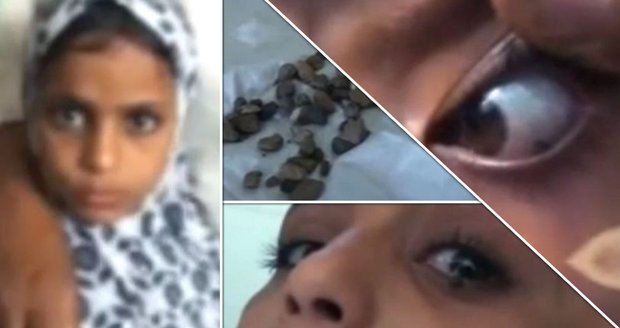 Jemenská dívka pláče kameny. Nikdo neví, co jí je. Místní si myslí, že posednutá ďáblem.