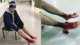 Mladý Australan utrpěl při napadení mořskými potvorami bolestivá zranění.