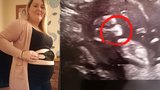 Nenarozené miminko vypadalo na ultrazvuku, že nosí v děloze roušku. Máma chytila za pár dní covid