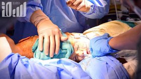 Saudskoarabští chirurgové oddělili syrská siamská dvojčata srostlá hlavami.