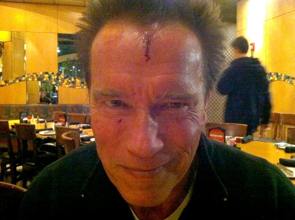 Arnold není neporazitelný, ukázal se s rozbitým čelem