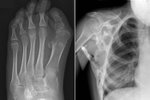 Podle výsledků studie z roku 2014 je artrózou celoživotně zasaženo 11,5 procenta obyvatel mezi 25 až 64 lety a s revmatoidní artritidou žije necelých pět procent dospělých Čechů.