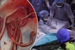 Děsivé záběry z nemocnice: Ze severokorejského uprchlíka doktoři vytáhli 25centimetrové červy.