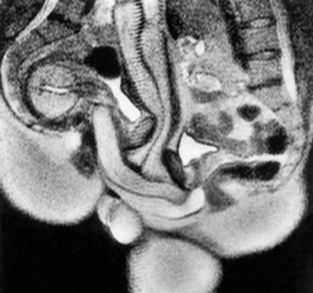 Hlavním nálezem prvního MRI skenu skutečného sexu byl penis, který během misionářské pozice získal tvar bumerangu.