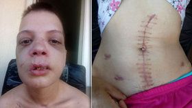 Tyto děsivé snímky zachycují zranění Bulharky donucené k prostituci. Když odmítala šlapat a pokusila se utéci, pasák jí brutálně zbil.