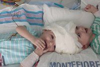 Lékaři 20 hodin oddělovali siamská dvojčata srostlá hlavami, v půlce málem zákrok odvolali!