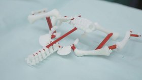 Díky 3D tiskárně získali lékaři trojrozměrný model koster obou chlapců.