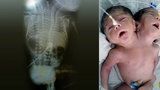 Dítě se narodilo s dvěma hlavami: Dva dny po porodu zemřelo