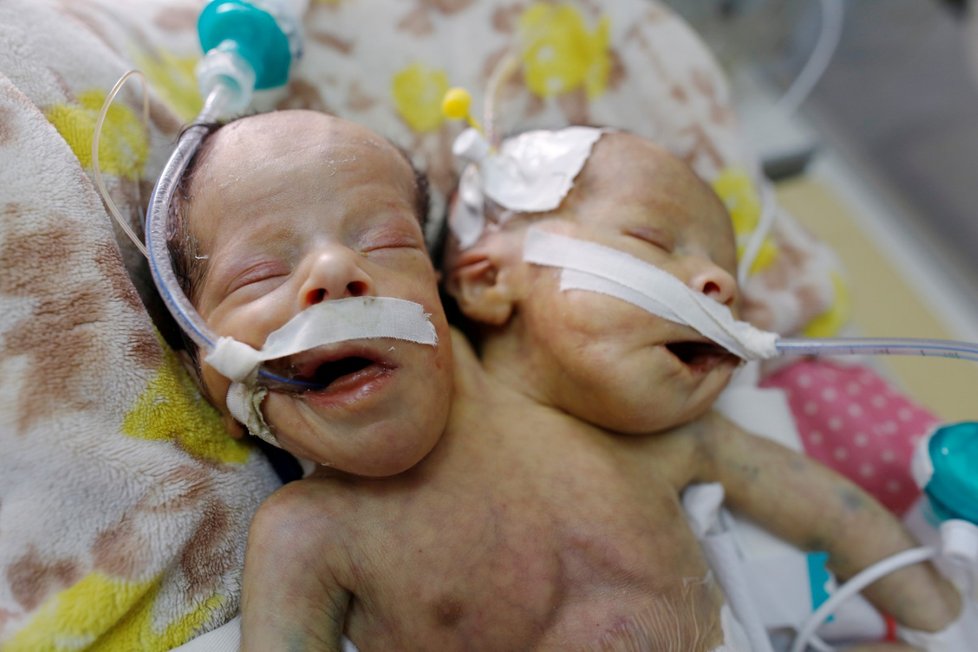 Lékaři z nemocnice v Saná požádali OSN a humanitární organizace o pomoc v případě záchrany života siamských dvojčat. (6.2.2019)