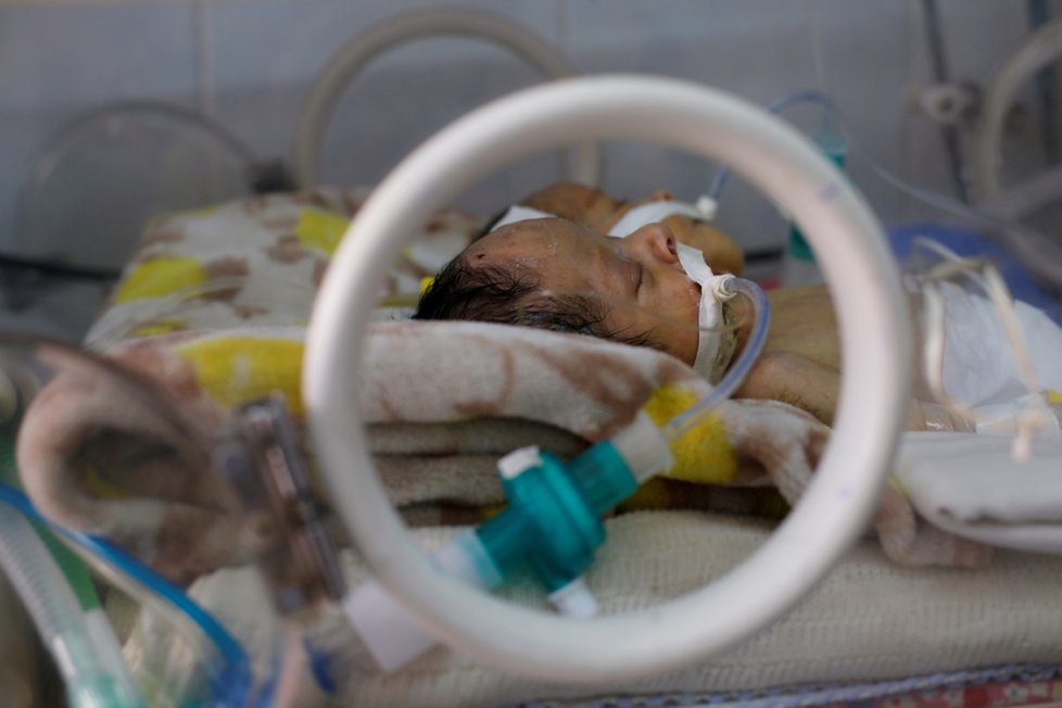 Lékaři z nemocnice v Saná požádali OSN a humanitární organizace o pomoc v případě záchrany života siamských dvojčat. (6.2.2019)