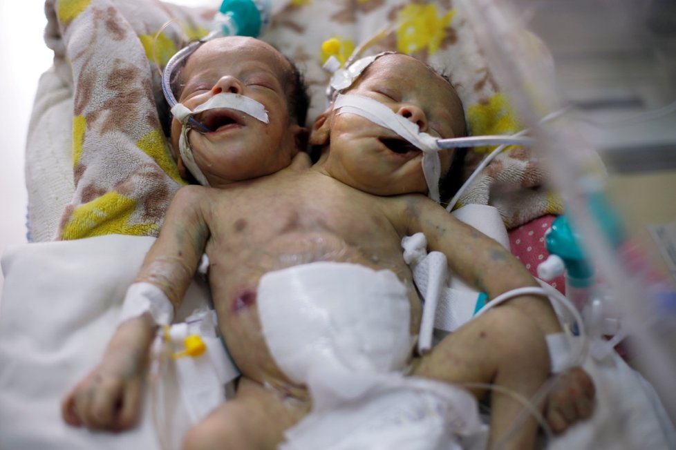 Siamská dvojčata podle lékařů bez pomoci v zahraničí nepřežijí. (6.12.2019)