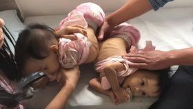 Úspěch doktorů: Oddělili siamská dvojčátka srostlá játry. Matka pláče štěstím