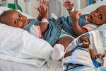 Lékaři oddělili siamská dvojčata srostlá pánví: Obě holčičky přežily¨.