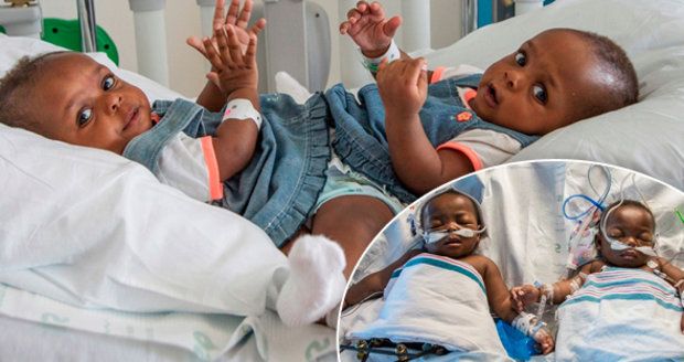 Lékaři oddělili siamská dvojčata srostlá pánví: Obě holčičky přežily