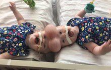 Siamská dvojčata: Jako dárek, dostali život!