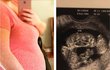 Snímek siamských dvojčat v těhotenství