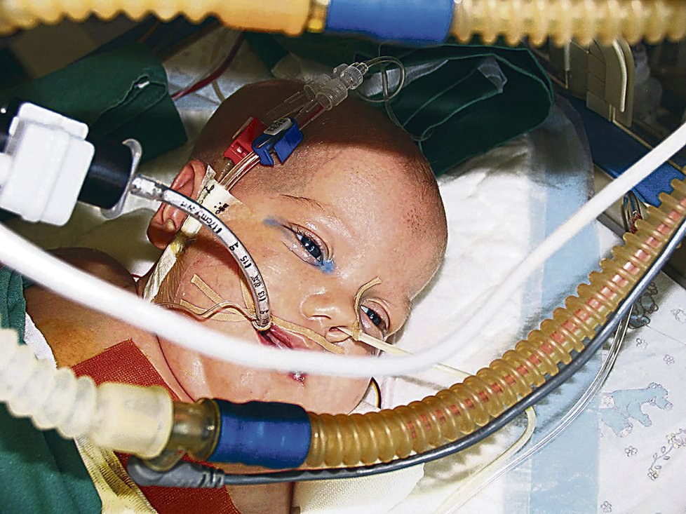 21. 9. 2007: Děti nejtěžší dny po operaci přežily, jejich stav však nadále komplikuje infekce, kterou se antibiotiky porazit nepodařilo.