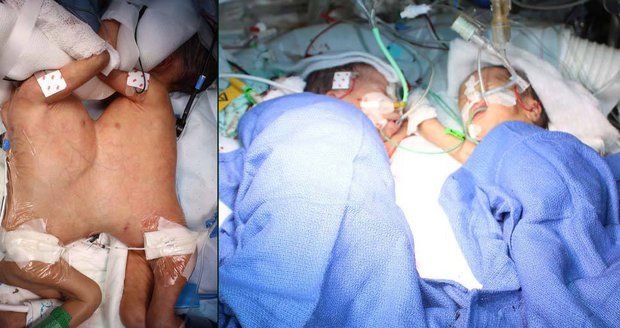 Obrovský úspěch lékařů: Oddělili osm dní stará siamská dvojčata!
