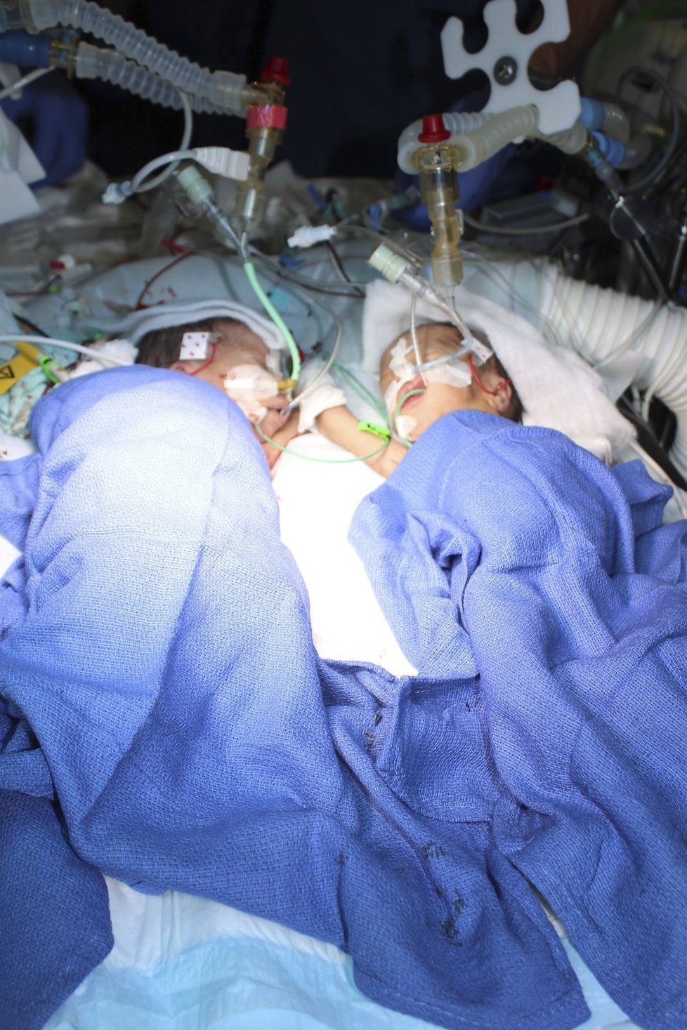 Lékaři ve Švýcarsku úspěšně oddělili nejmladší siamská dvojčata.