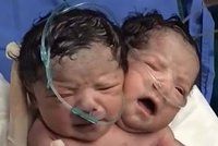 Dvouhlavé miminko: Siamská dvojčata mají dva mozky, vnitřní orgány jsou společné