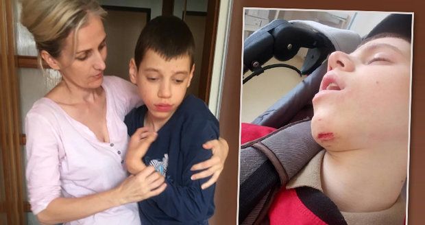 Hororová péče o dítě: Postiženého syna vrátili matce z ústavu s rozbitou bradou a modřinami