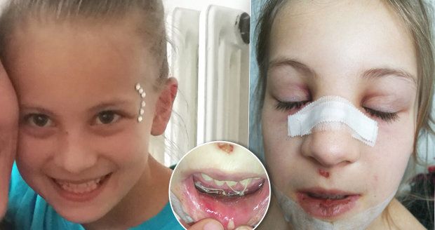 Holčička z Blatné si po pádu ve škole zlomila nos a utrhla bradu od čelisti: Učitelka nezavolala záchranku