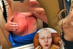 Anička Slováčková ukázala spáleniny na prsu po ozařování.