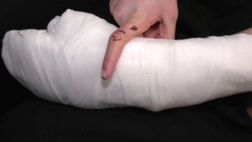 Přišel o články tří prstů