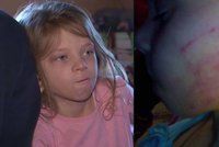 Vystrašené holčičce (6) zubařka dala facku: Z ordinace vyšla s otiskem její ruky na tváři