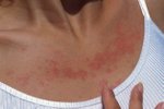 Sluneční alergie se projevuje kožní erupcí.