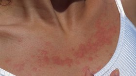 Sluneční alergie se projevuje kožní erupcí.