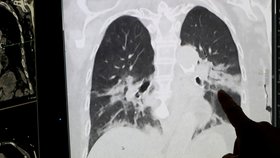 Belgická nemocnice Regional de la Citadelle Hospital zveřejnila snímek plic pod rentgenem, kde je vidět, jak covid-19 postihuje tento životně důležitý orgán (22.4.2020)