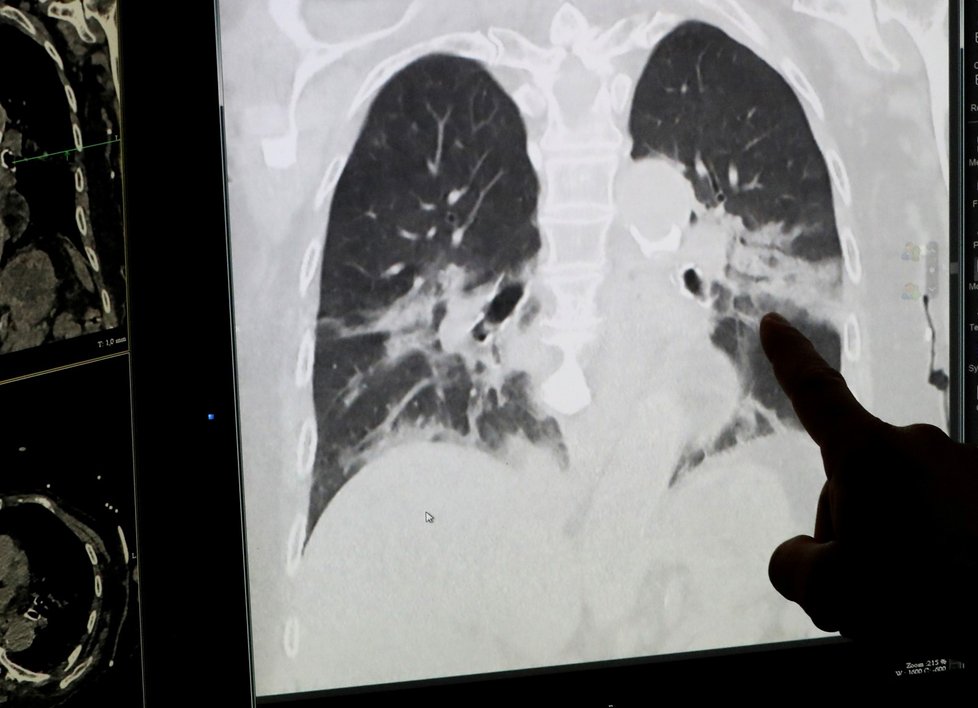 Belgická nemocnice Regional de la Citadelle Hospital zveřejnila snímek plic pod rentgenem, kde je vidět, jak covid-19 postihuje tento životně důležitý orgán. (22.4.2020)