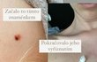 Soňa Porupková sdílela svůj příběh o rakovině kůže...