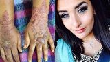 Místo tetování ruce plné puchýřů! Sophie (22) varuje před černou hennou