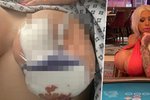 Bývalé pornohvězdě vyhnil implantát! Teď z nemocnice žebrá o peníze na další operaci