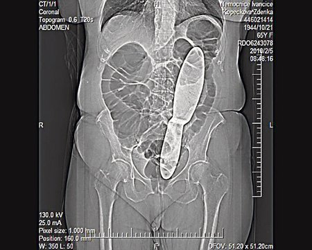 Rentgenový snímek Zdenky Kopečkové je víc než výmluvný a svědčí o skandální chybě zdravotníků z Ivančic: na dlouhých pět měsíců jí nechali v těle 28 cm dlouhou chirurgickou špachtli!