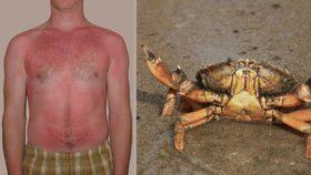 Lidé zkoušeli reklamovat dovolené například kvůli spálení kůže od slunce nebo krabům na pláži.