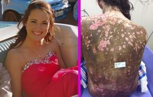 Žena (19) bojuje o život po vzácné reakci na léky: Hoří jí kůže! 