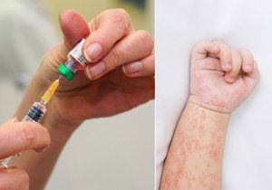 Očkování představuje nejlepší způsob, jak získat imunitu proti spalničkám