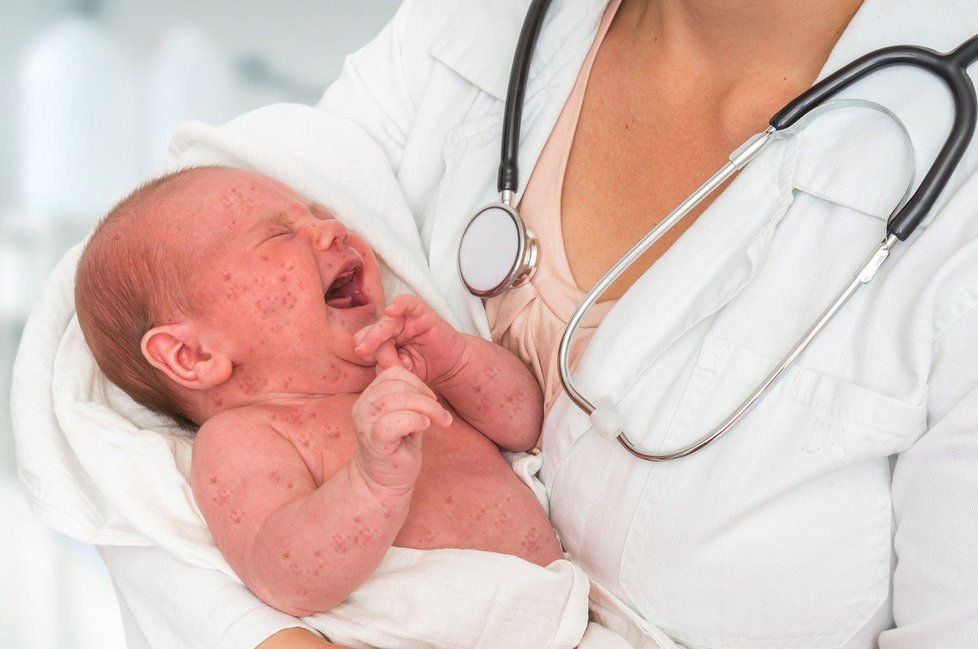 Ve světě výrazně přibylo lidí, kteří se nakazili spalničkami. V prvních třech měsících letošního roku jich touto virovou chorobou onemocnělo 112.163, což je téměř čtyřikrát více než ve stejném období loni.