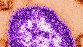 Hrozí Česku epidemie spalniček?