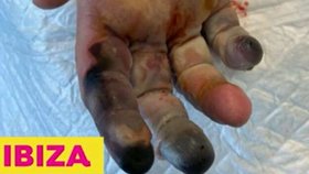 Mladíka pokousaného pavoukem nejspíš čeká amputace dvou a půl prstu. Hmyz ho rafl na pláži na Ibize.