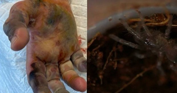 Mladíka kousnul pavouk: Ruka mu zfialověla a čeká ho amputace prstů
